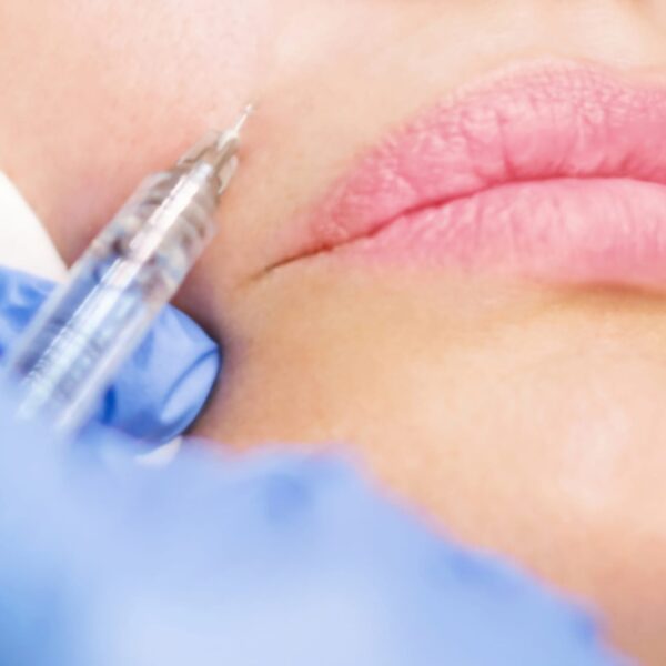 Nasal Fold Filler